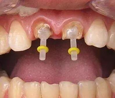 牙根打桩在线视频,在线视频教学全解析